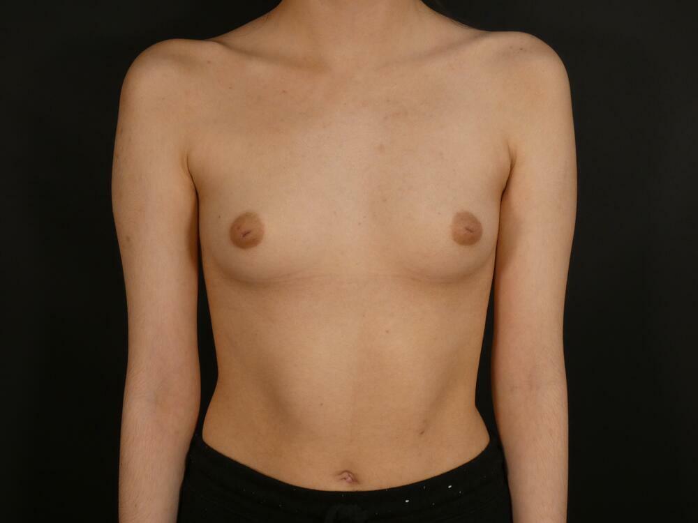 Inverted Nipple Correction Before & After