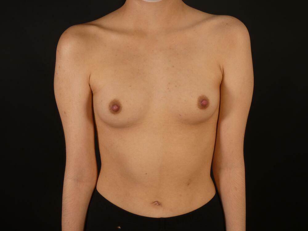 Inverted Nipple Correction Before & After