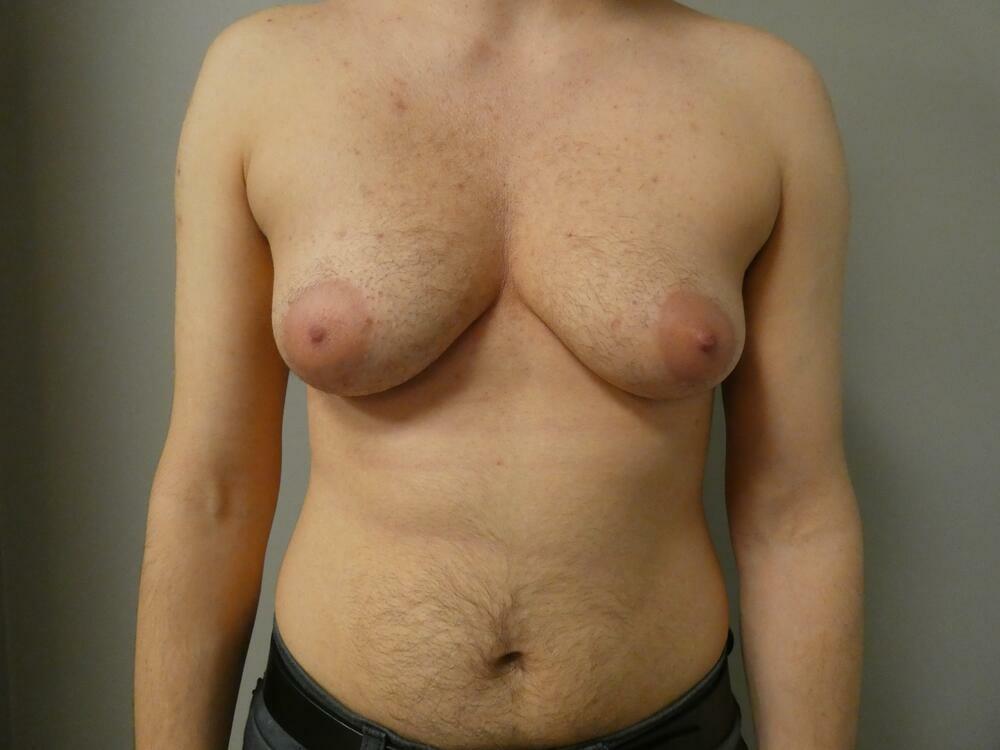 Transmasculine Top Surgery Before & After