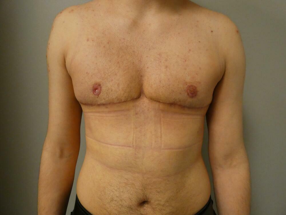 Transmasculine Top Surgery Before & After