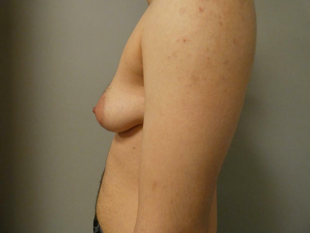 Transmasculine Top Surgery Before & After
