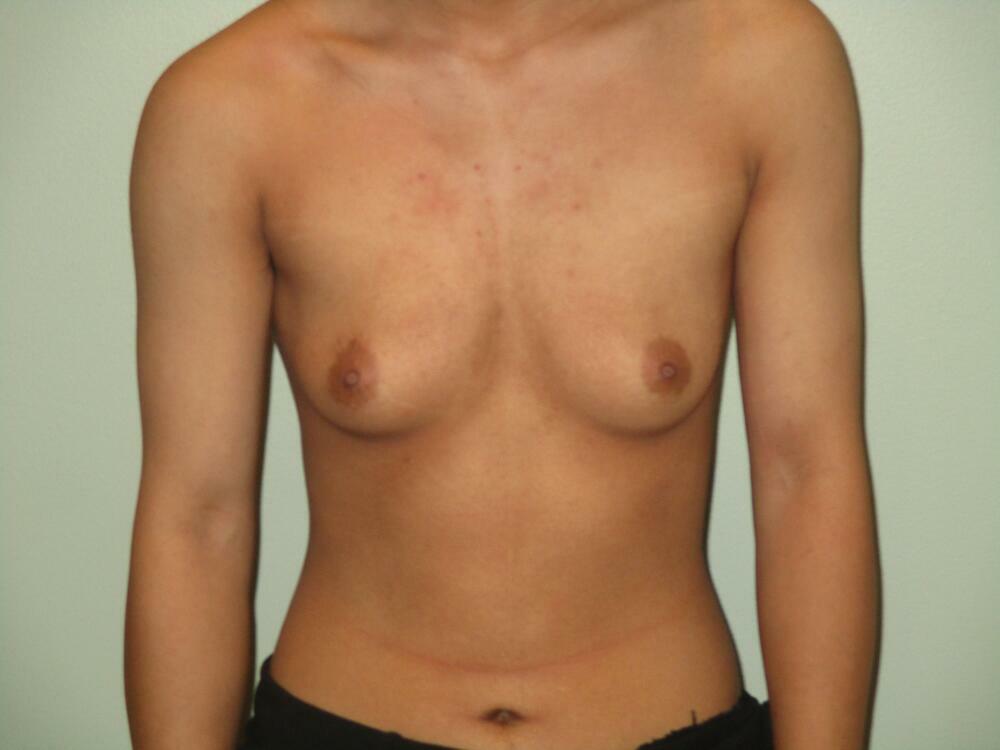 Transmasculine Top Surgery Before & After