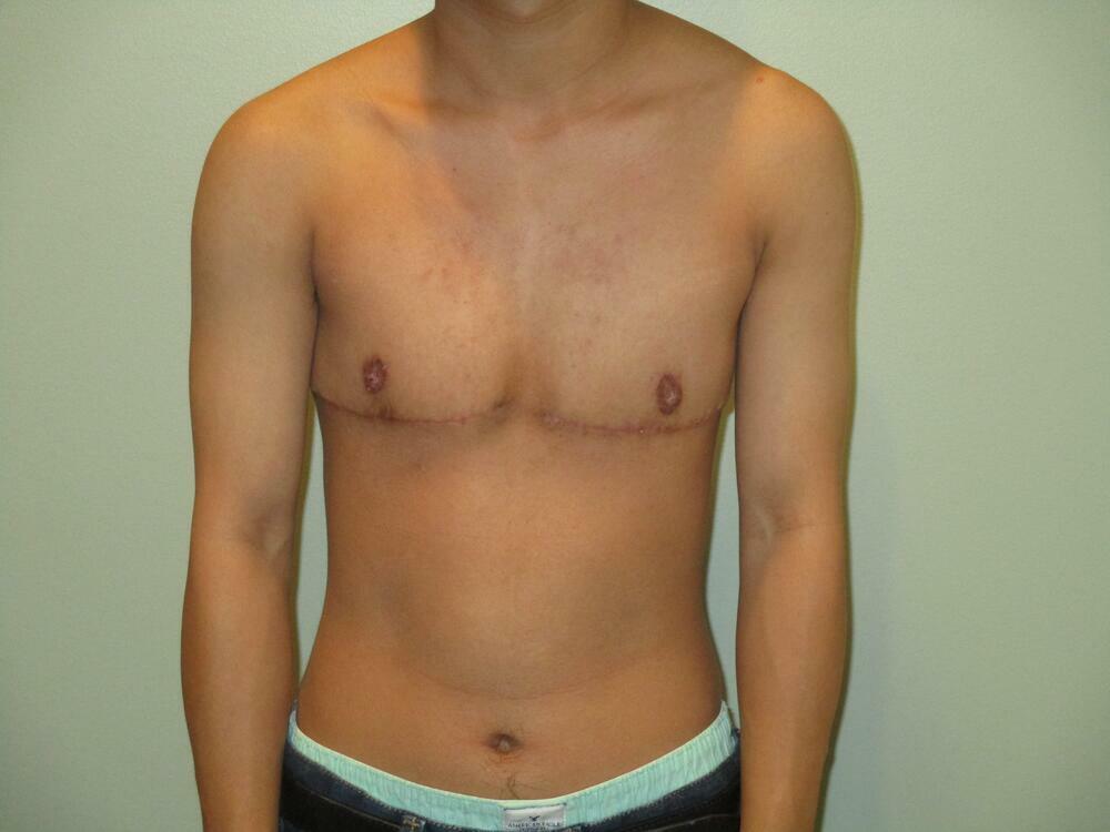Transmasculine Top Surgery Before & After