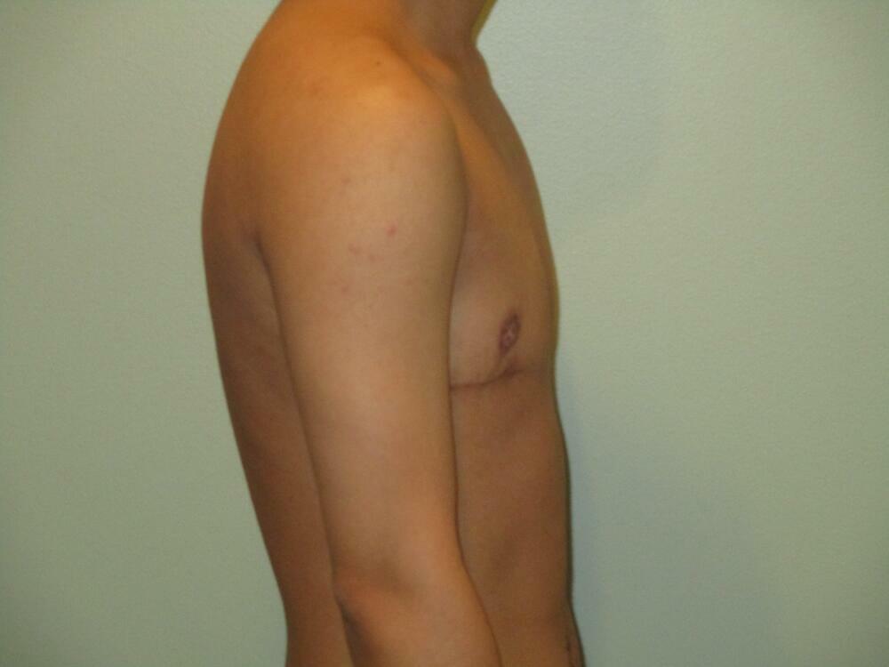 Transmasculine Top Surgery Before & After