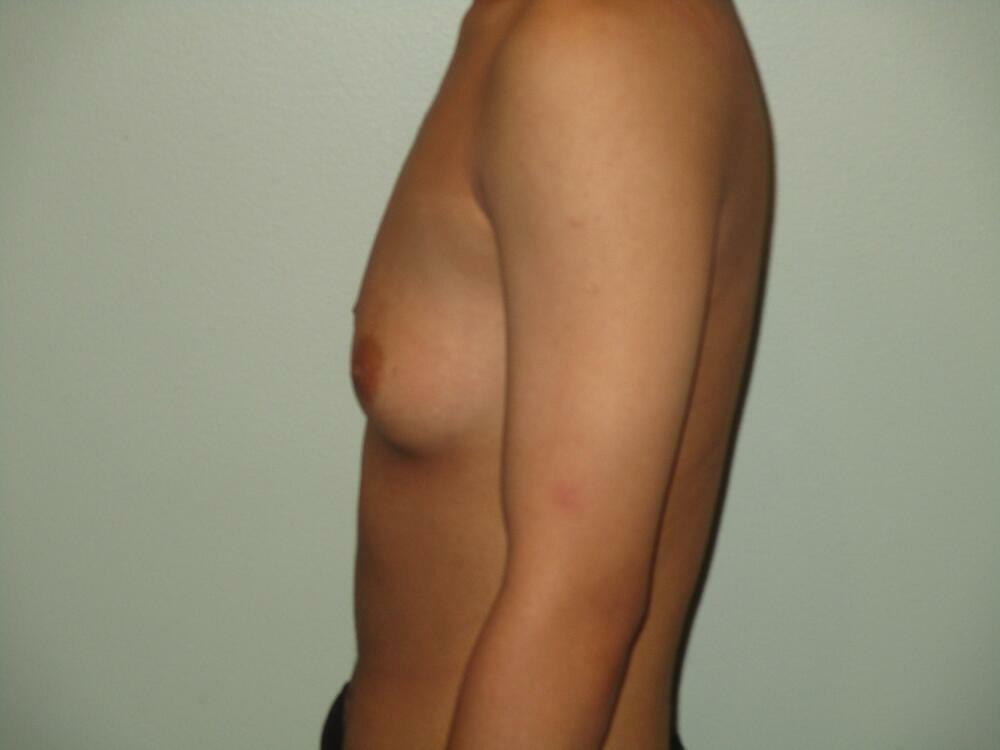 Transmasculine Top Surgery Before & After