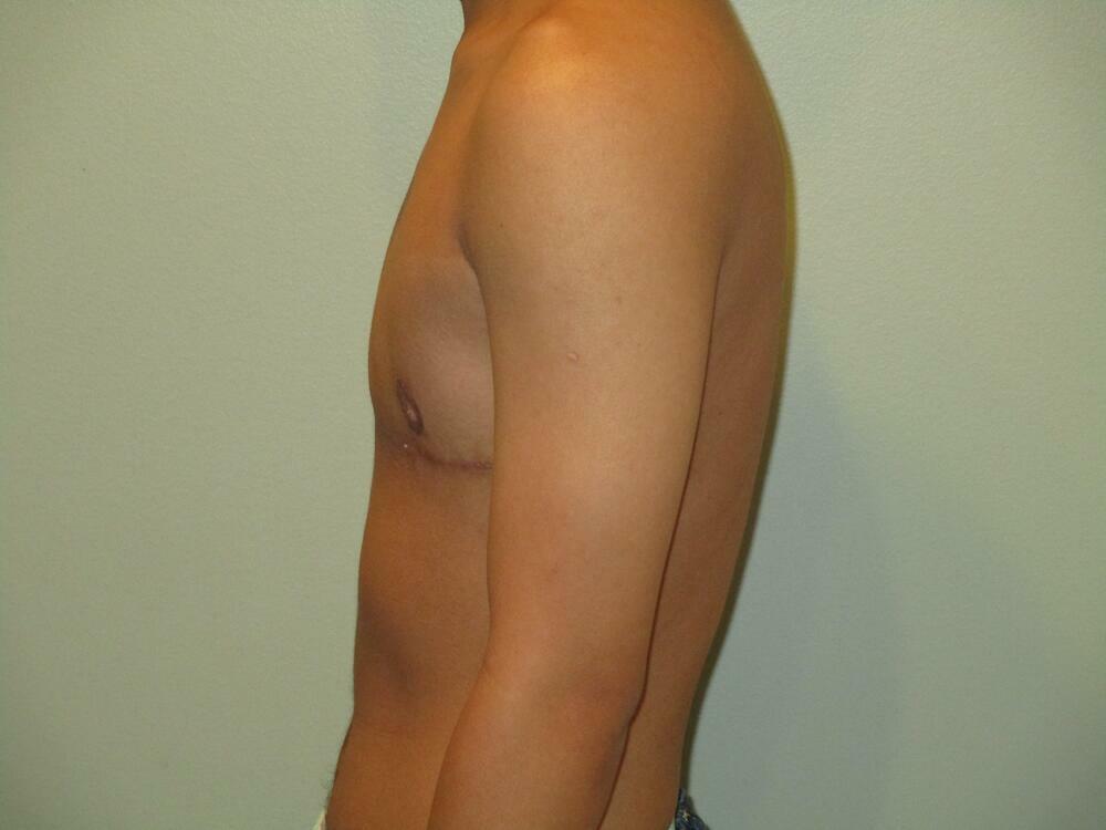 Transmasculine Top Surgery Before & After