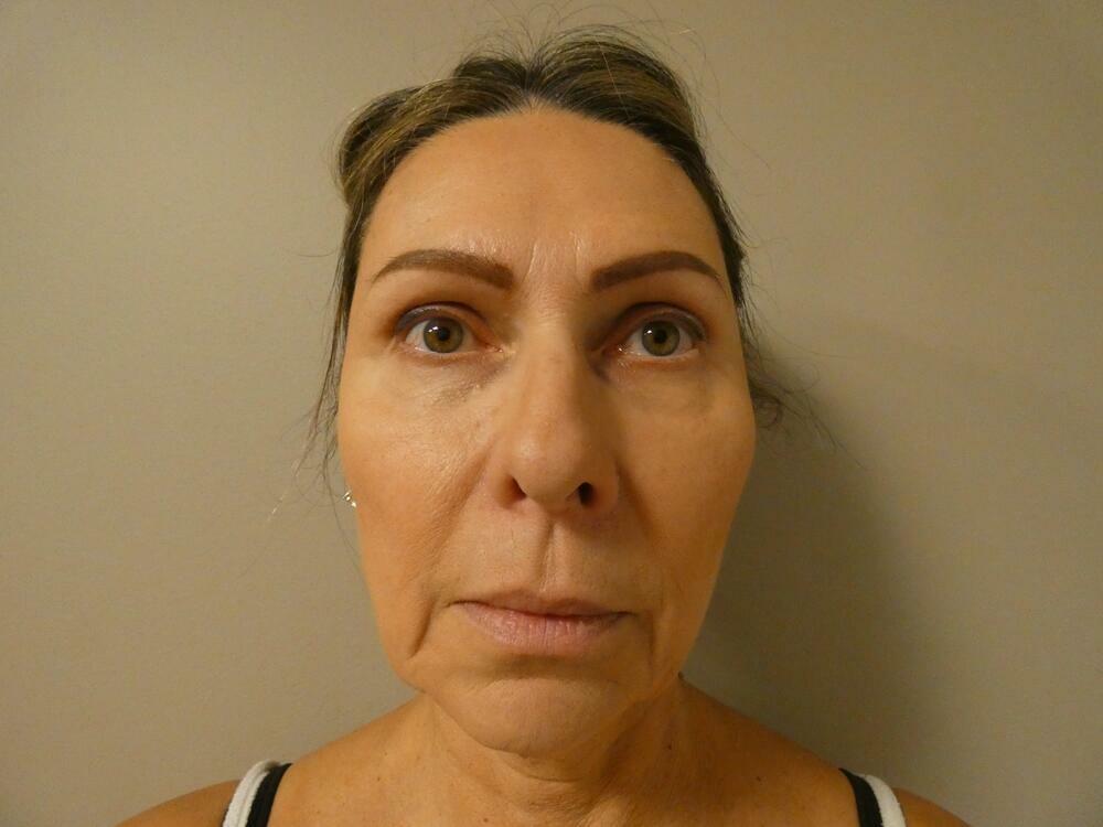 Eyelid Lift  Before & After