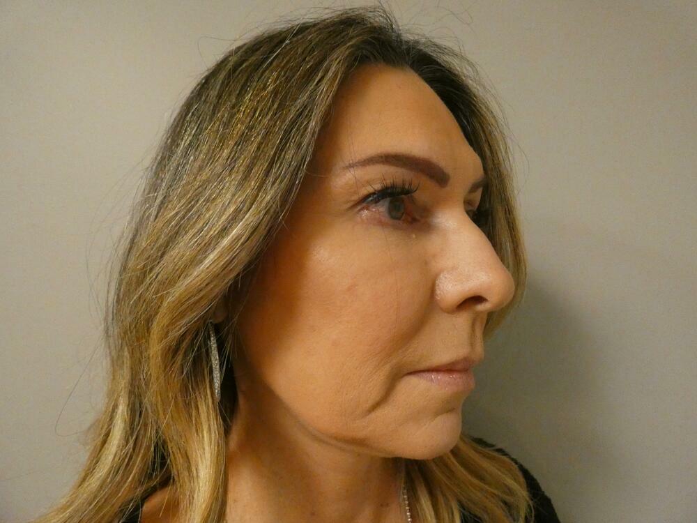 Eyelid Lift  Before & After