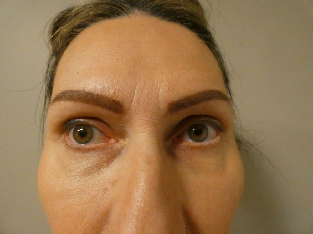 Eyelid Lift  Before & After