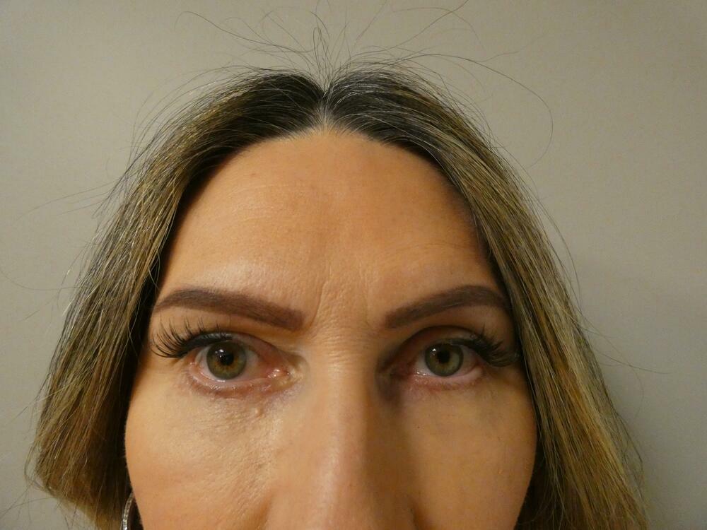 Eyelid Lift  Before & After