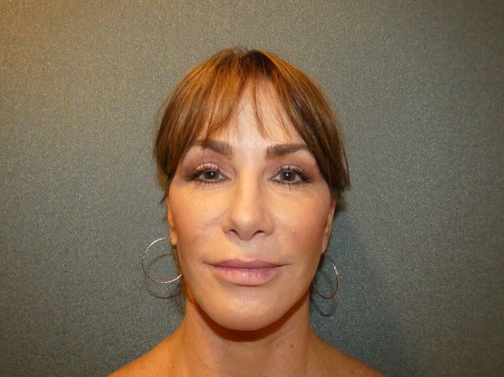 Facelift  Before & After