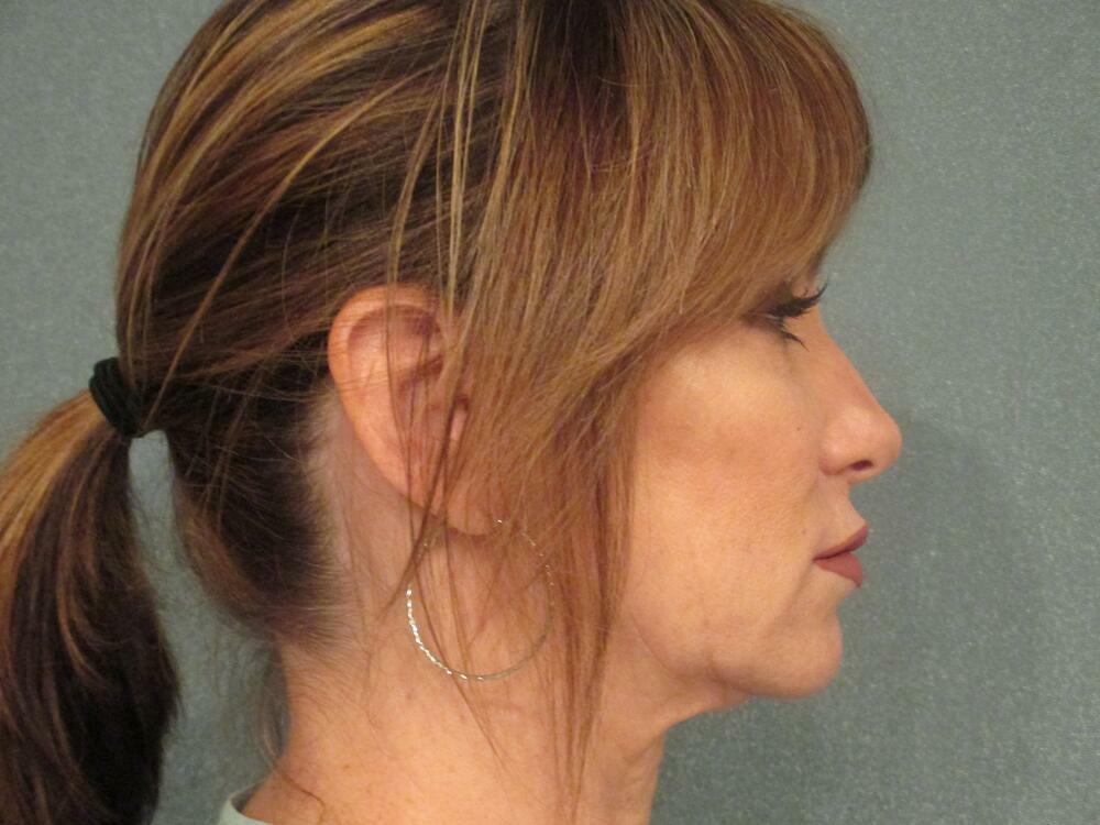 Facelift  Before & After