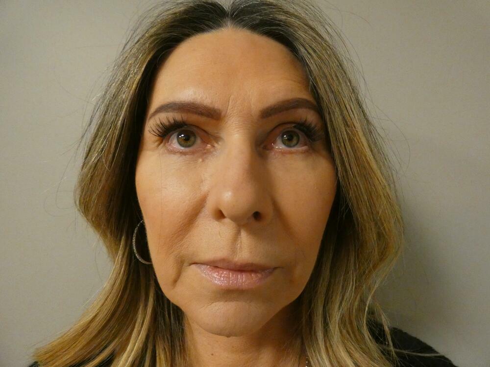 Facelift  Before & After