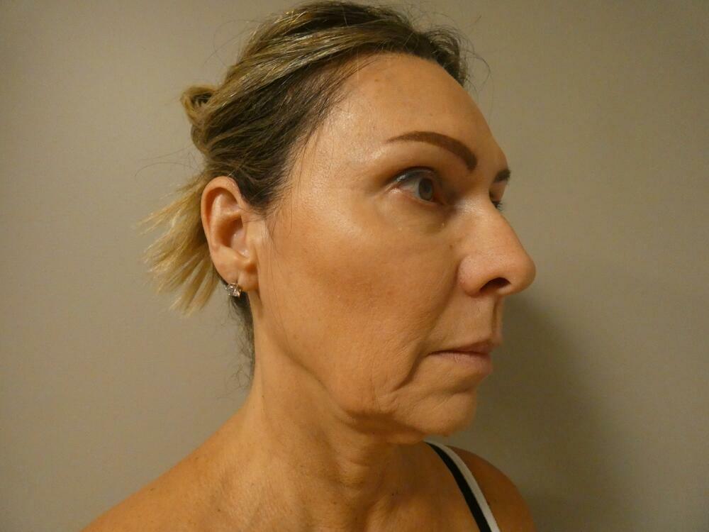 Facelift  Before & After