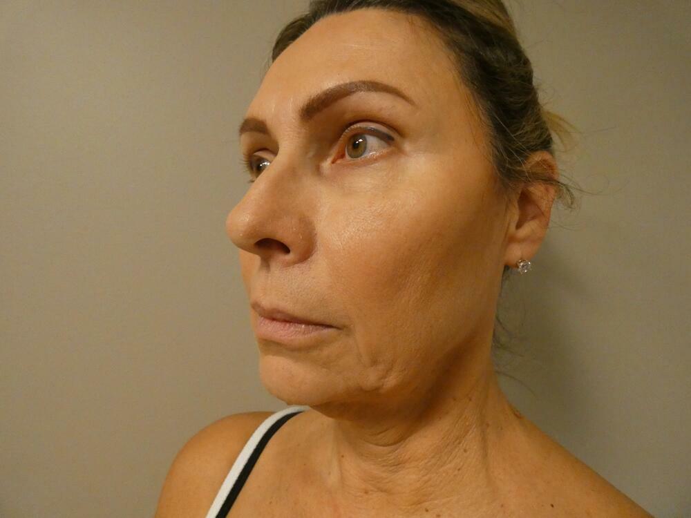 Facelift  Before & After