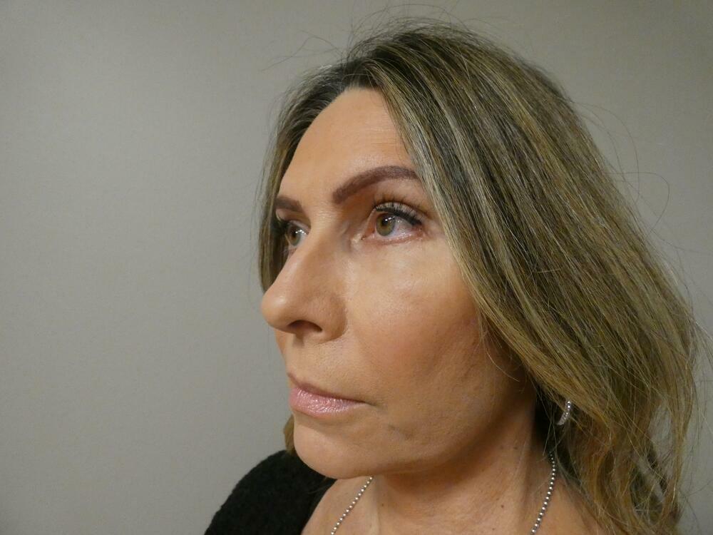 Facelift  Before & After