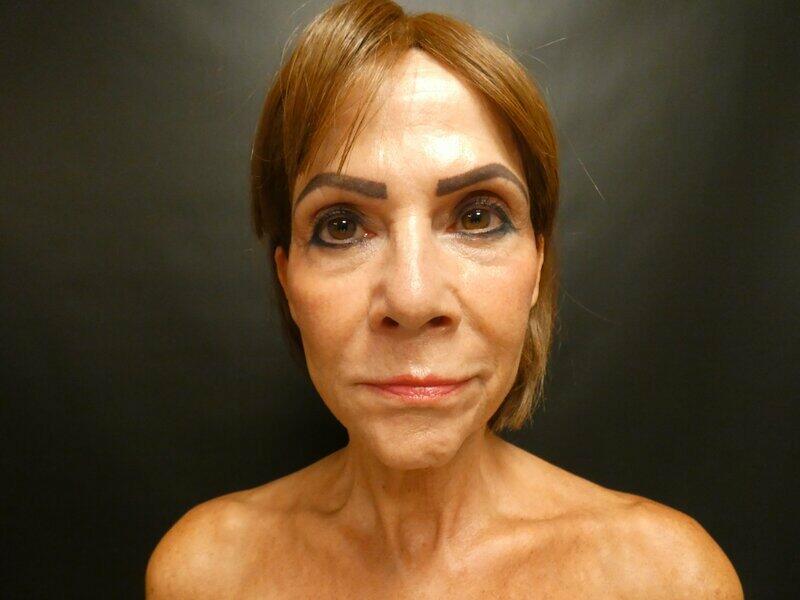 Facelift  Before & After