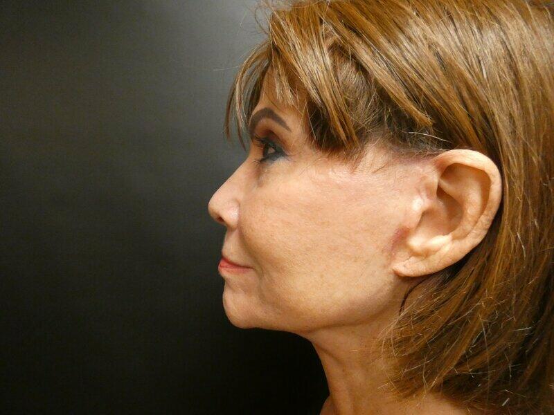 Facelift  Before & After