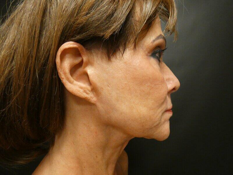 Facelift  Before & After