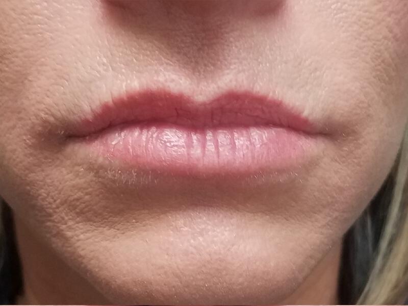 Lip Fillers Before & After