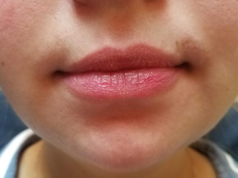 Lip Fillers Before & After