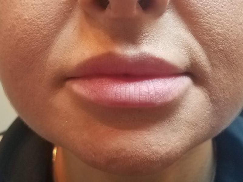 Lip Fillers Before & After