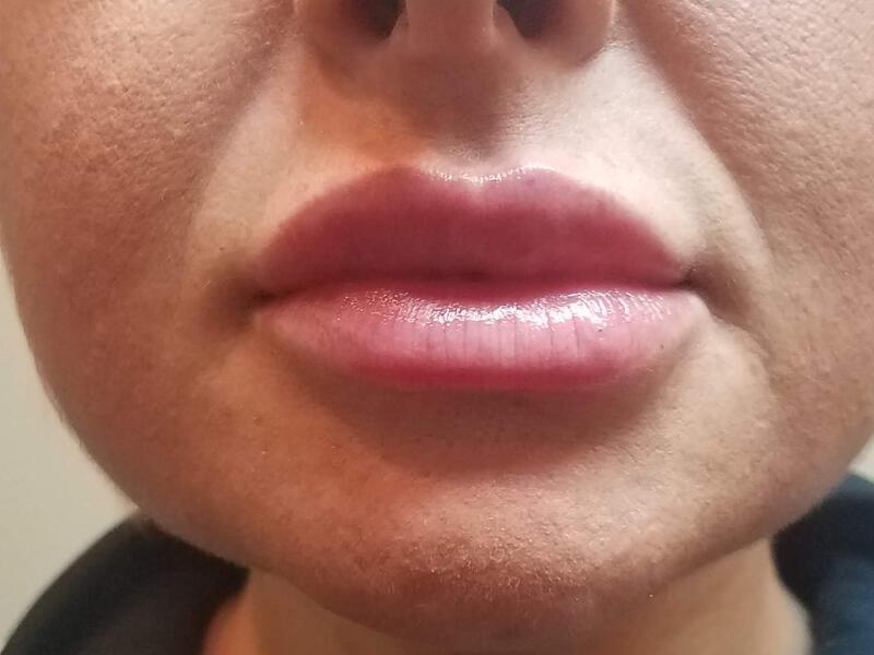 Lip Fillers Before & After