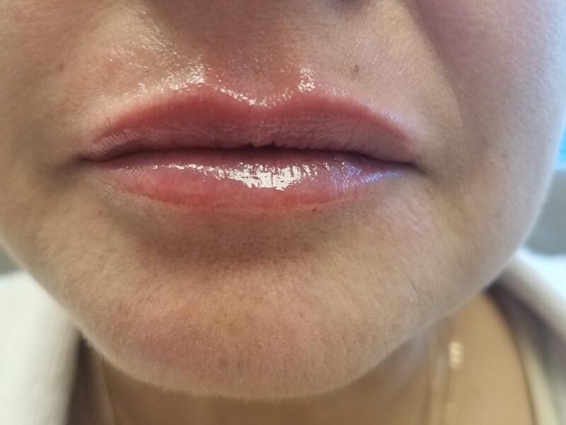 Lip Fillers Before & After