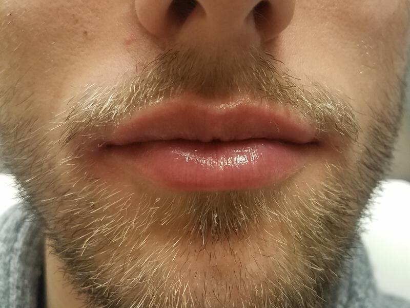 Lip Fillers Before & After