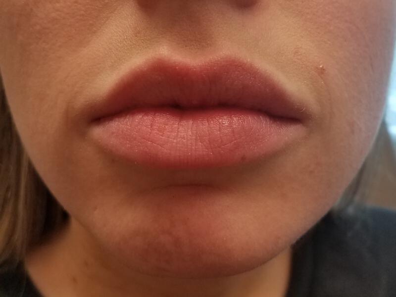 Lip Fillers Before & After