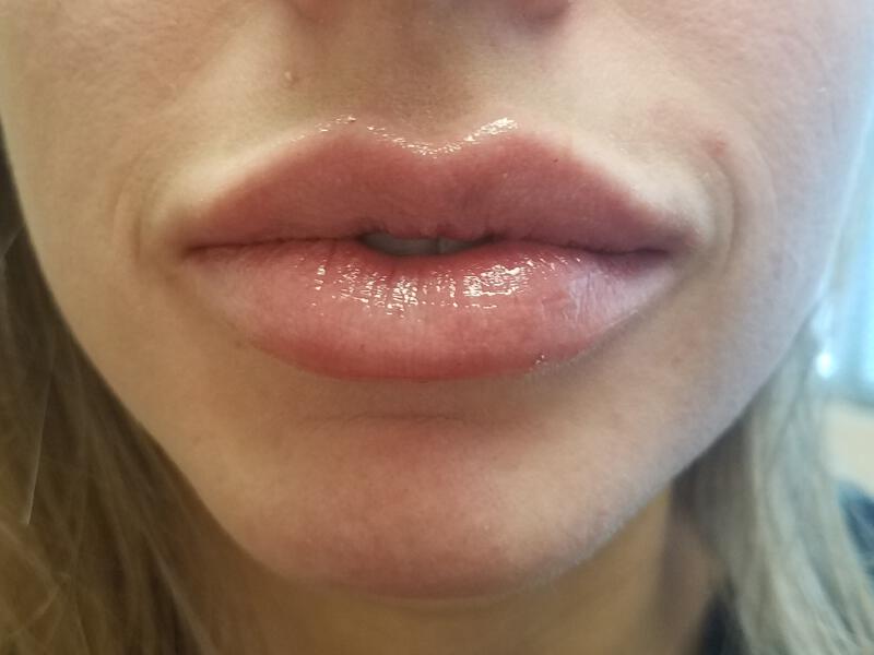 Lip Fillers Before & After