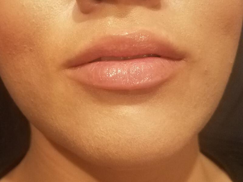 Lip Fillers Before & After