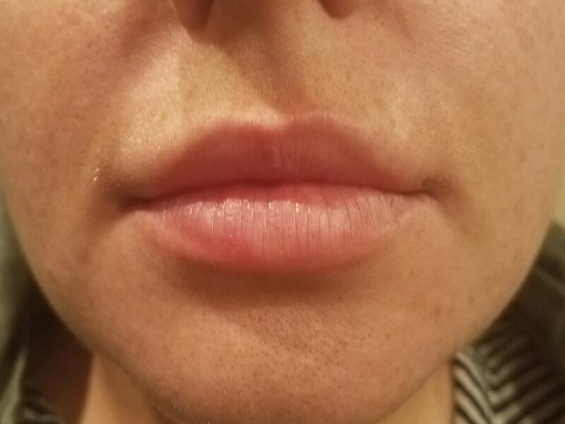 Lip Fillers Before & After