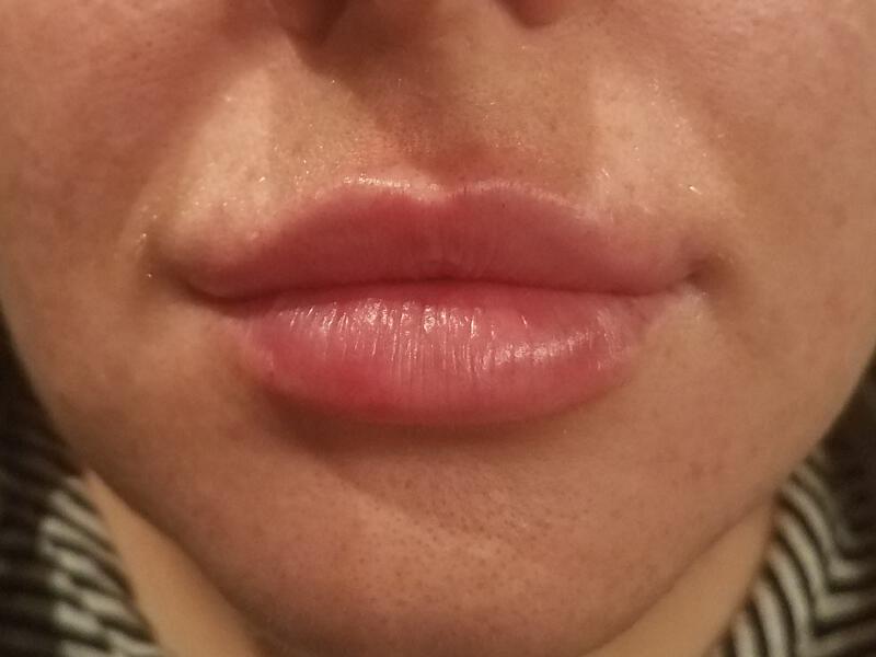 Lip Fillers Before & After