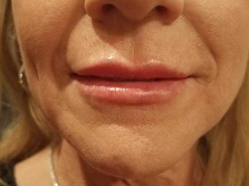 Lip Fillers Before & After