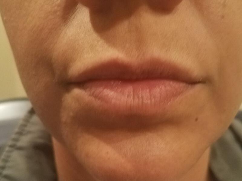 Lip Fillers Before & After