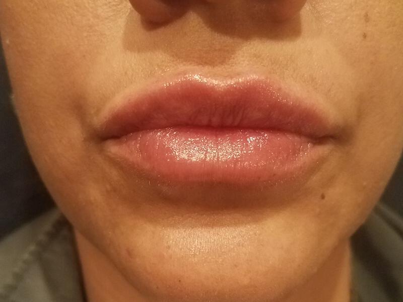 Lip Fillers Before & After