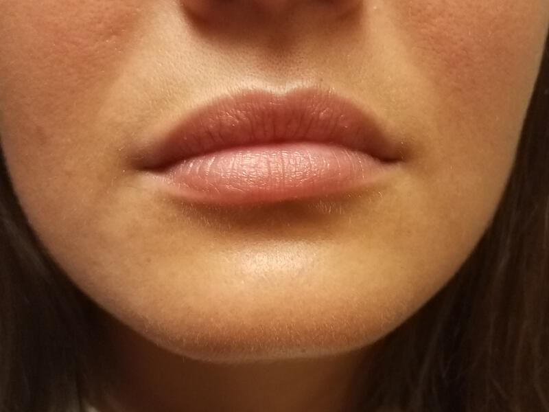 Lip Fillers Before & After