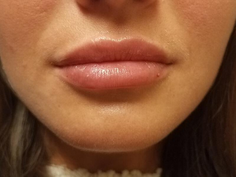 Lip Fillers Before & After