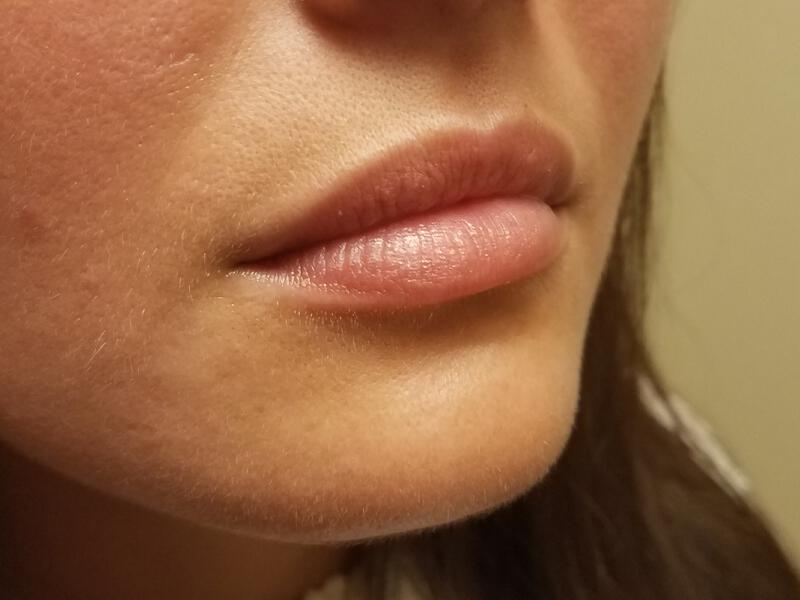 Lip Fillers Before & After