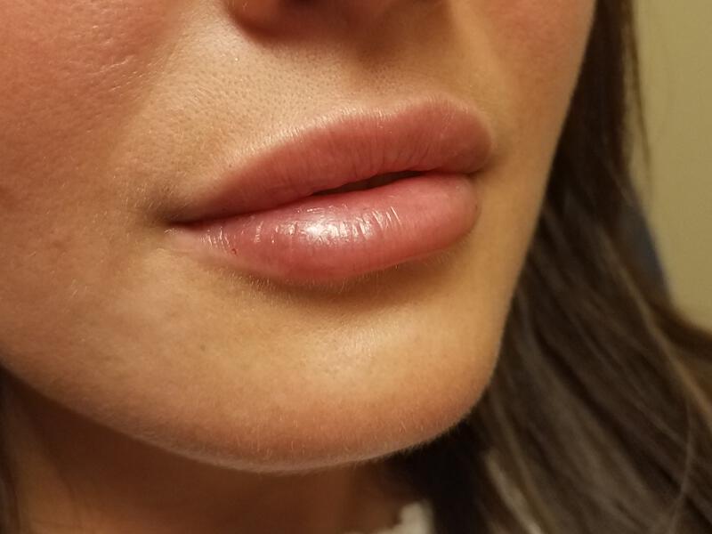 Lip Fillers Before & After