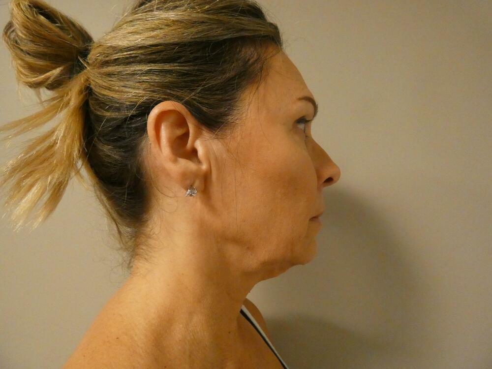 Neck Lift Before & After