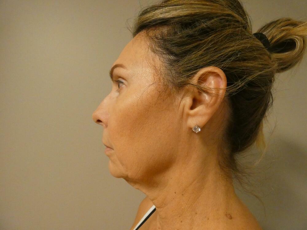 Neck Lift Before & After