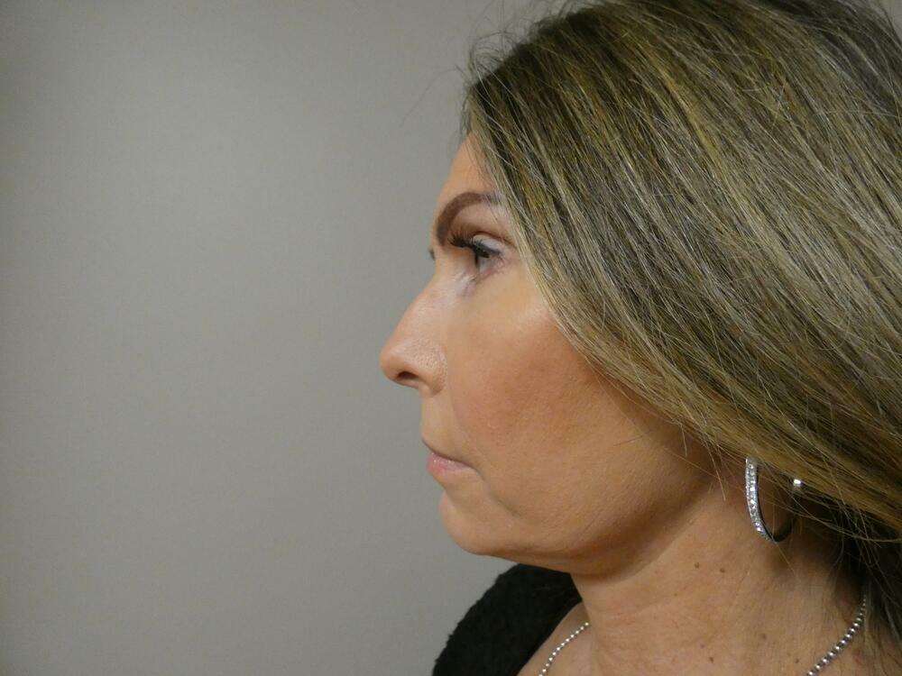 Neck Lift Before & After