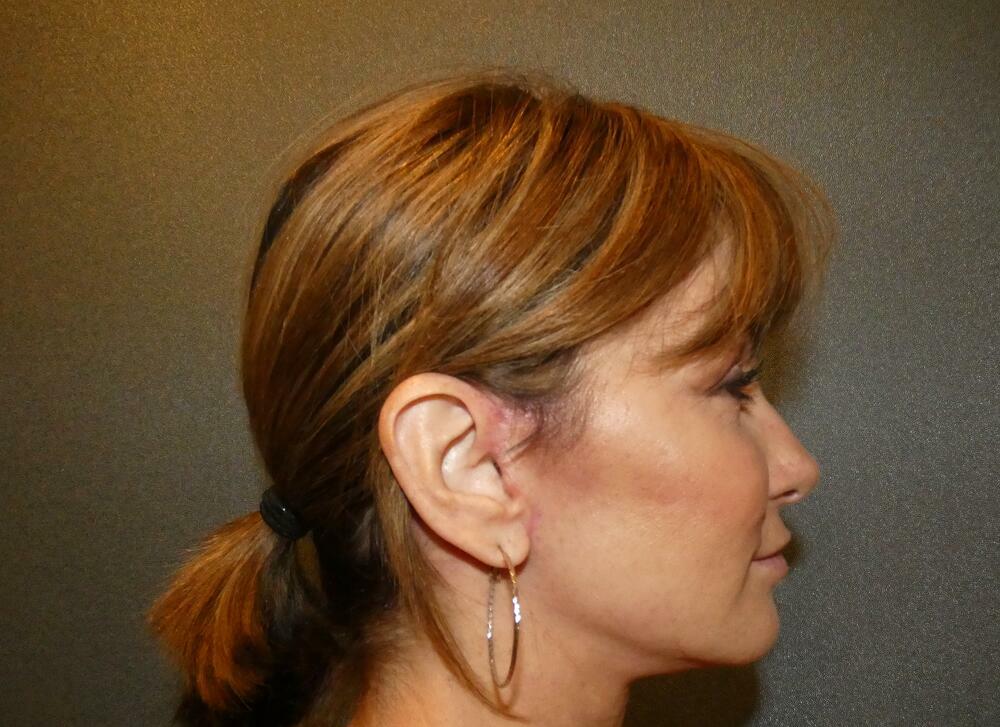 Neck Lift Before & After