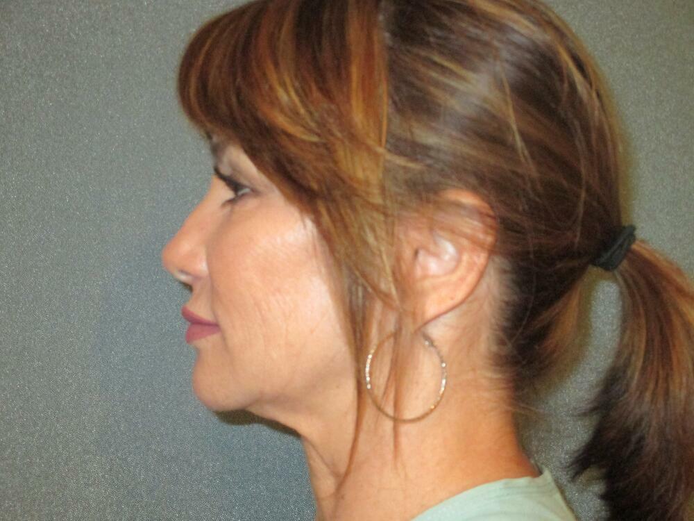 Neck Lift Before & After