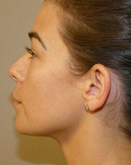 Ear Surgery Otoplasty  Before & After