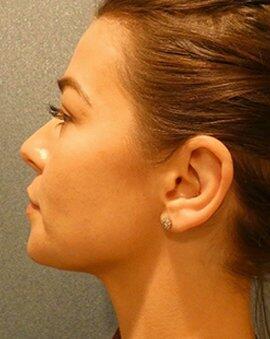 Ear Surgery Otoplasty  Before & After