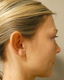 Ear Surgery Otoplasty  Before & After