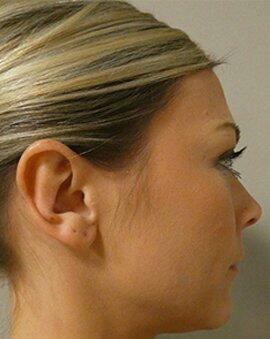 Ear Surgery Otoplasty  Before & After